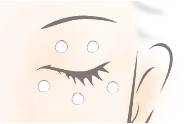 用眼霜長脂肪粒是什么原因 眼部脂肪粒怎么去除